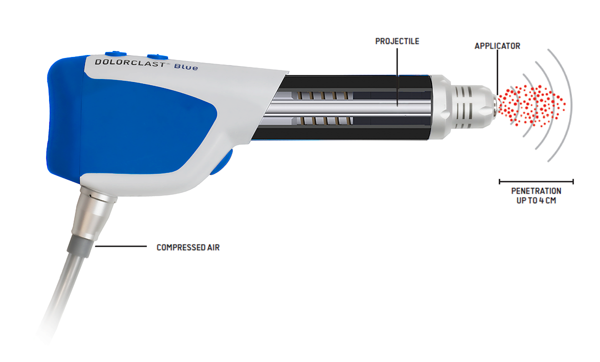 Radial pressure wave technology used in shockwave therapy treatments