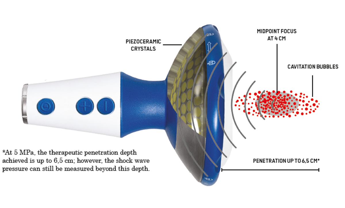dolorclast focused shock waves usa mechanism